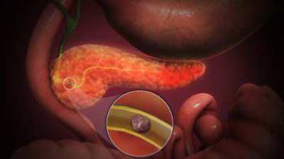 pancrea